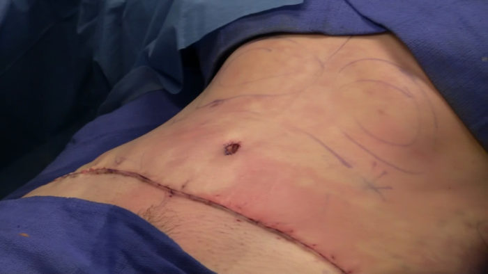 Abdominoplasty_completely_sutured