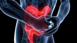 HG871_colon-ulcerative-colitis_FS