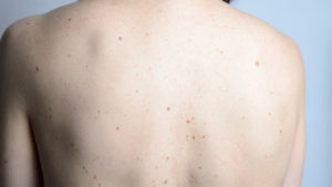 Close up detail of the bare skin on a womans back with scattered moles and freckles