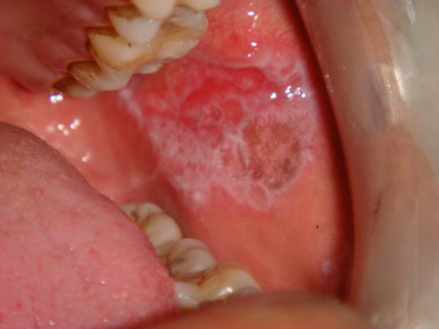 2211939_white-patch-on-buccal-mucosa_620